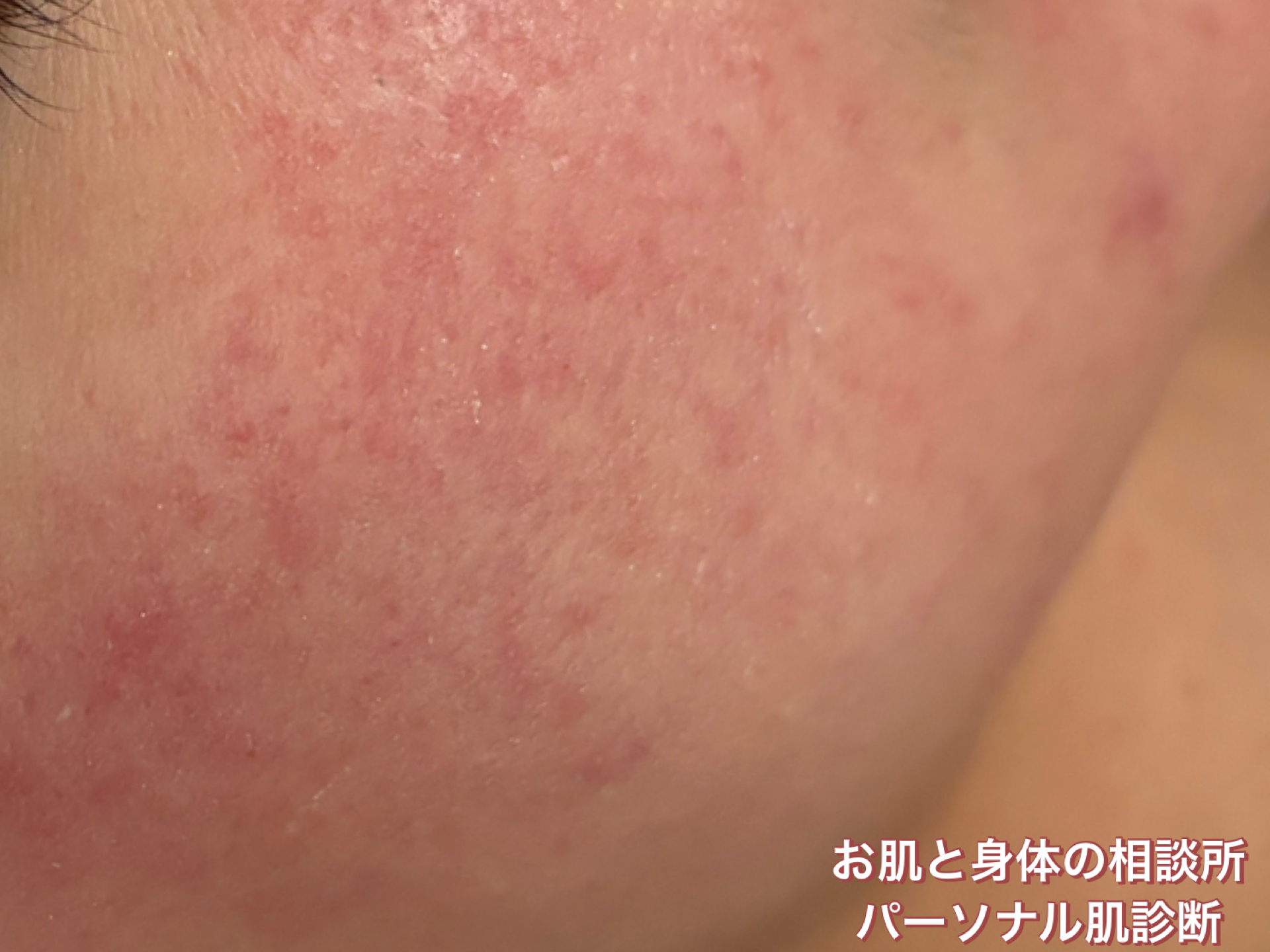 長年肌のことで悩んできた方のご相談時の肌の様子