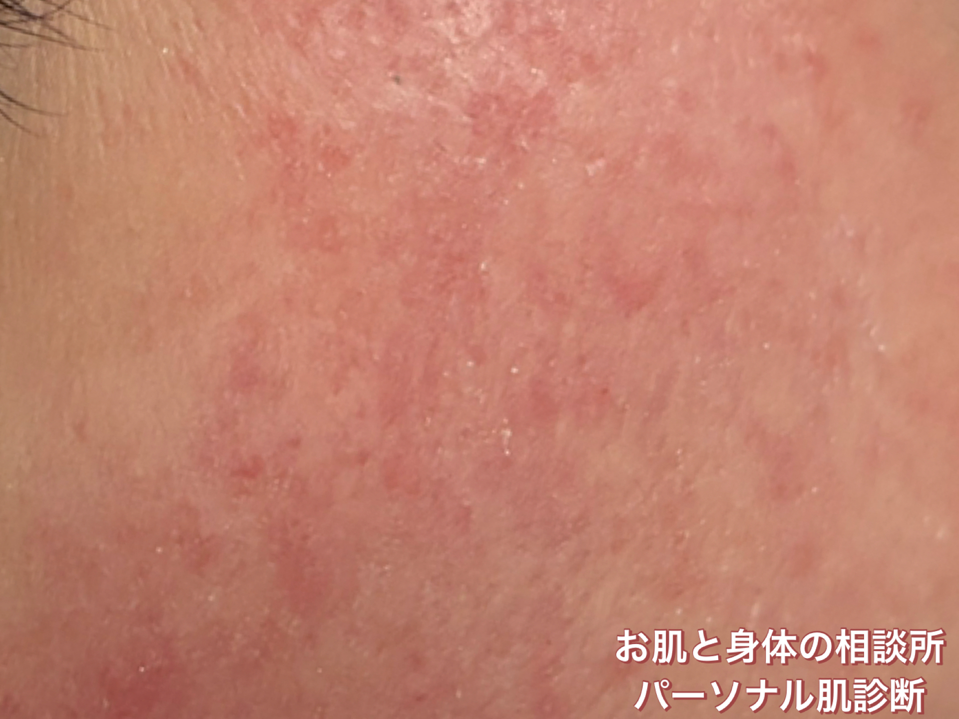 長年肌のことで悩んできた方の肌の様子