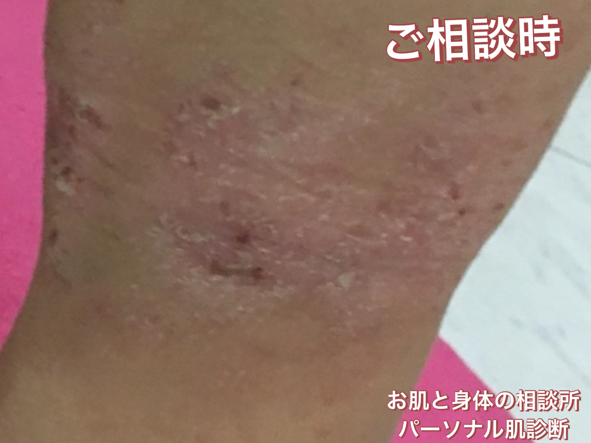 お子さまの身体の肌についてご相談いただいた際のお写真